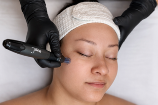 Customized Skin Renewal: From Microdermabrasion to Advanced Microneedling