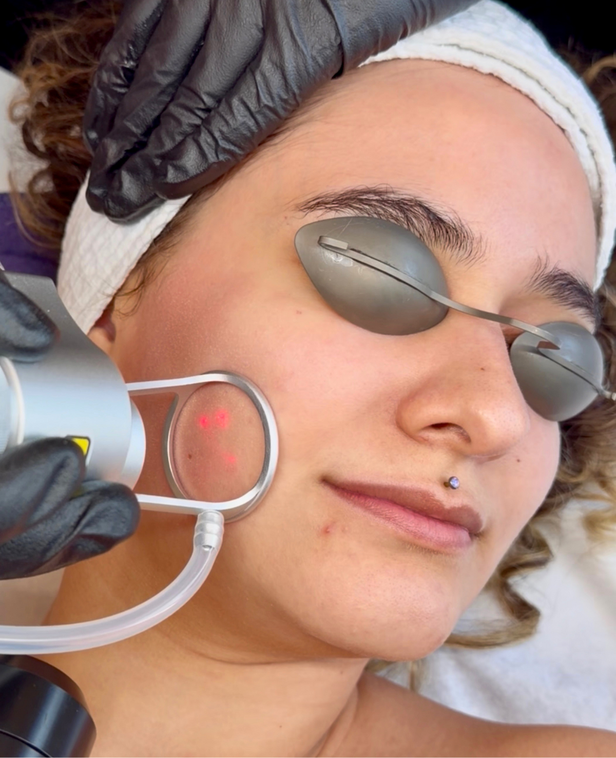 Person receiving co2 laser treatment on their face.